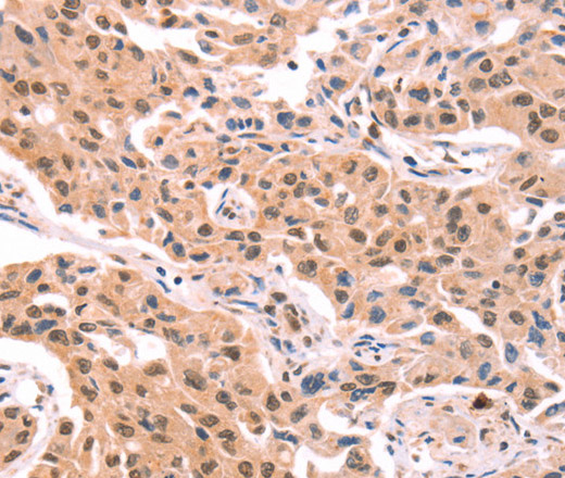 Immunohistochemistry of paraffin-embedded Human lung cancer tissue using PROS1 Polyclonal Antibody at dilution 1:40