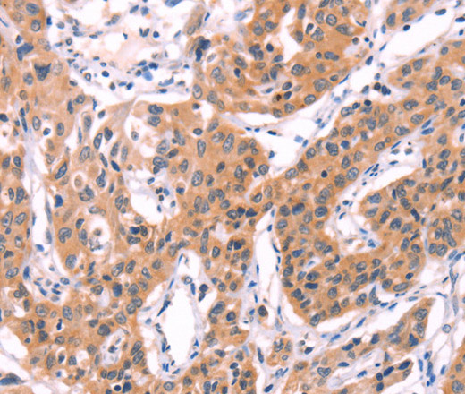 Immunohistochemistry of paraffin-embedded Human lung cancer using SERPINA5 Polyclonal Antibody at dilution of 1:40