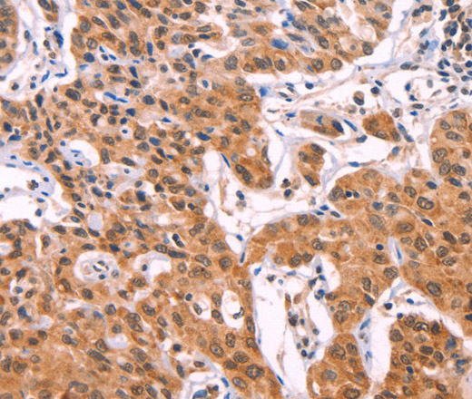 Immunohistochemistry of paraffin-embedded Human lung cancer using ST2 Polyclonal Antibody at dilution of 1:70