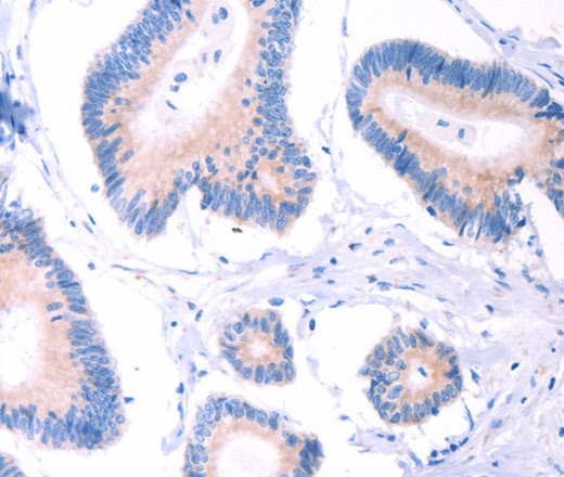 Immunohistochemistry of paraffin-embedded Human colon cancer using AADAC Polyclonal Antibody at dilution of 1:30