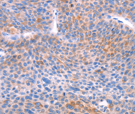 Immunohistochemistry of paraffin-embedded Human liver cancer using AADAC Polyclonal Antibody at dilution of 1:30