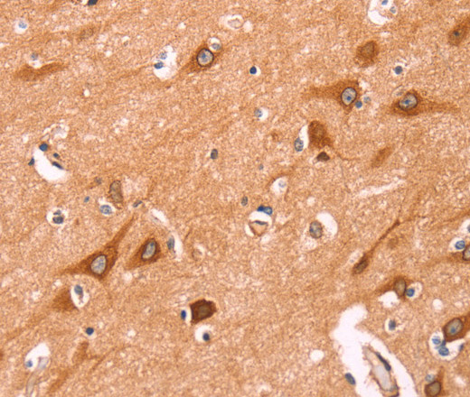 Immunohistochemistry of paraffin-embedded Human thyroid cancer using NCEH1 Polyclonal Antibody at dilution of 1:80