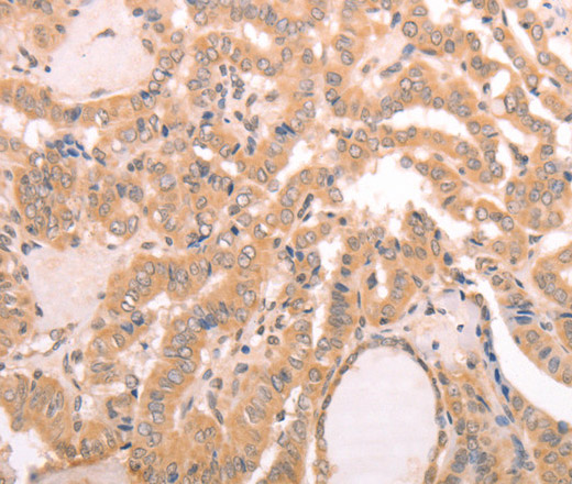 Immunohistochemistry of paraffin-embedded Human thyroid cancer using AASDHPPT Polyclonal Antibody at dilution of 1:30