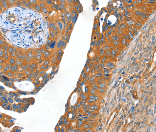 Immunohistochemistry of paraffin-embedded Human cervical cancer using ACOT11 Polyclonal Antibody at dilution of 1:40