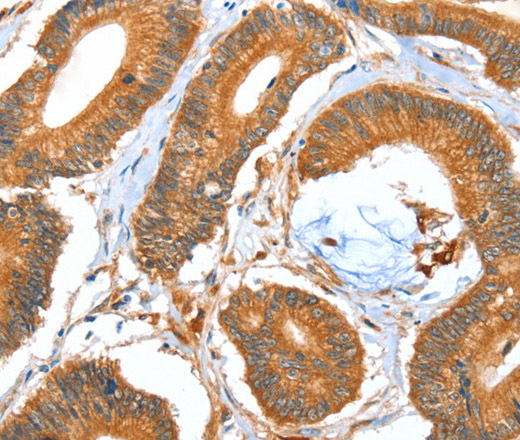 Immunohistochemistry of paraffin-embedded Human colon cancer using ACOT11 Polyclonal Antibody at dilution of 1:40