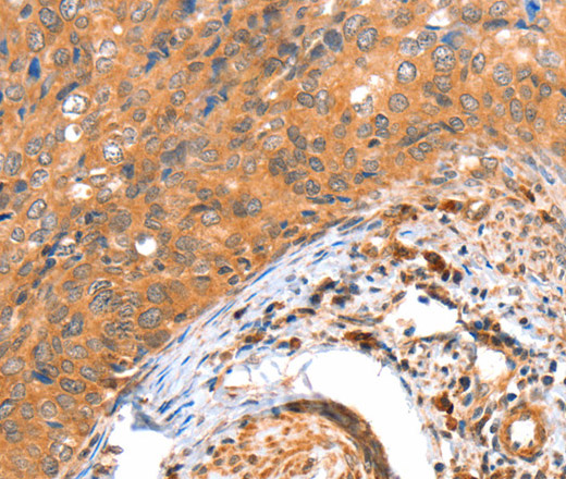 Immunohistochemistry of paraffin-embedded Human cervical cancer tissue using ACOX3 Polyclonal Antibody at dilution 1:35