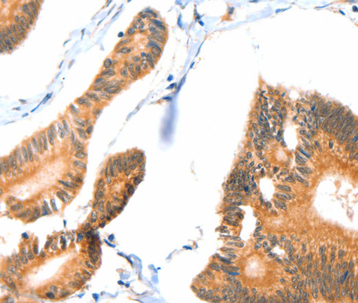 Immunohistochemistry of paraffin-embedded Human colon cancer tissue using ACOX3 Polyclonal Antibody at dilution 1:35