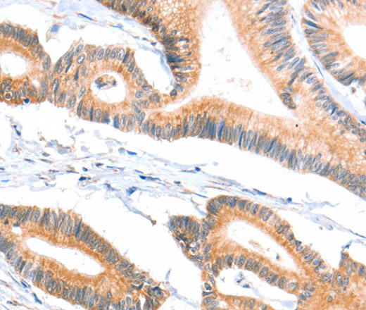 Immunohistochemistry of paraffin-embedded Human colon cancer tissue using ACSBG1 Polyclonal Antibody at dilution 1:40