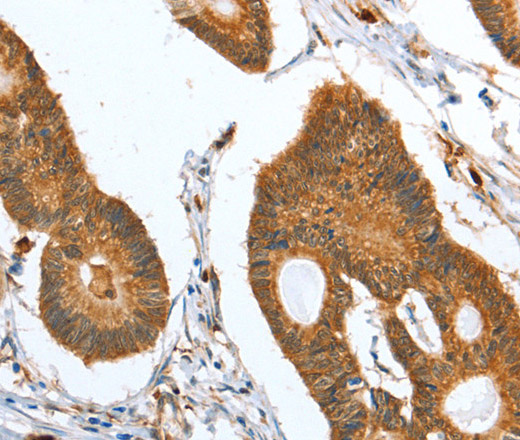 Immunohistochemistry of paraffin-embedded Human colon cancer using CAPG Polyclonal Antibody at dilution of 1:35