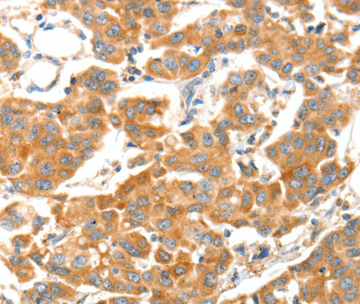 Immunohistochemistry of paraffin-embedded Human breast cancer tissue using ADAMTS18 Polyclonal Antibody at dilution 1:30