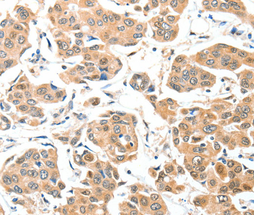 Immunohistochemistry of paraffin-embedded Human breast cancer tissue using ADCK1 Polyclonal Antibody at dilution 1:40