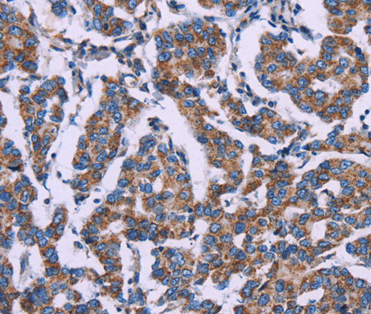 Immunohistochemistry of paraffin-embedded Human breast cancer using AGFG1 Polyclonal Antibody at dilution of 1:50