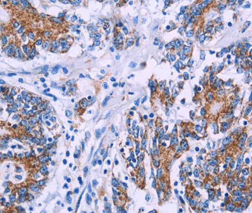 Immunohistochemistry of paraffin-embedded Human colon cancer using AGFG1 Polyclonal Antibody at dilution of 1:50