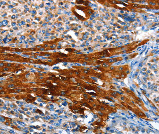 Immunohistochemistry of paraffin-embedded Human liver cancer using AOX1 Polyclonal Antibody at dilution of 1:65