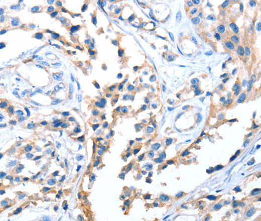 Immunohistochemistry of paraffin-embedded Human esophagus cancer using AOX1 Polyclonal Antibody at dilution of 1:65