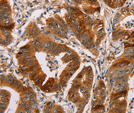 Immunohistochemistry of paraffin-embedded Human gastic cancer using ALDH3A1 Polyclonal Antibody at dilution of 1:55