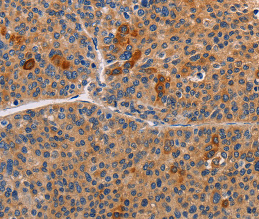 Immunohistochemistry of paraffin-embedded Human liver cancer using ALDH3A1 Polyclonal Antibody at dilution of 1:55