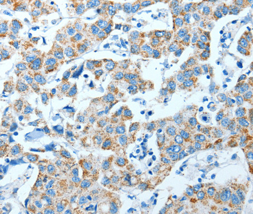 Immunohistochemistry of paraffin-embedded Human breast cancer using ALDH4A1 Polyclonal Antibody at dilution of 1:35