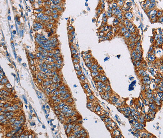 Immunohistochemistry of paraffin-embedded Human gasrtic cancer tissue using ALG2 Polyclonal Antibody at dilution 1:35