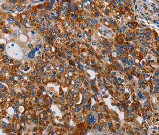 Immunohistochemistry of paraffin-embedded Human lung cancer tissue using ALG2 Polyclonal Antibody at dilution 1:35