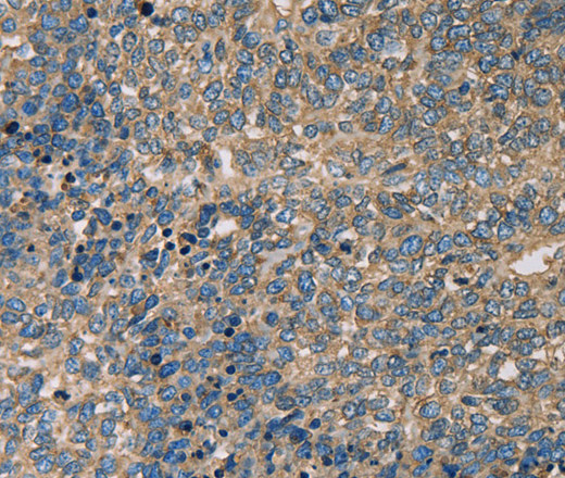 Immunohistochemistry of paraffin-embedded Human ovarian cancer tissue using SERPINA1 Polyclonal Antibody at dilution 1:50