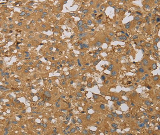 Immunohistochemistry of paraffin-embedded Human thyroid cancer using AHSG Polyclonal Antibody at dilution of 1:60