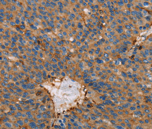 Immunohistochemistry of paraffin-embedded Human liver cancer using ACTA1 Polyclonal Antibody at dilution of 1:65