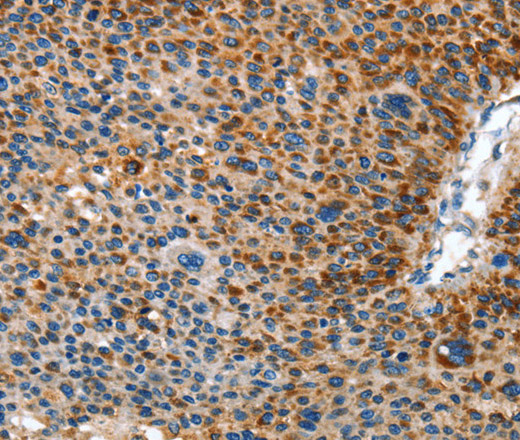 Immunohistochemistry of paraffin-embedded Human liver cancer using AMDHD2 Polyclonal Antibody at dilution of 1:40