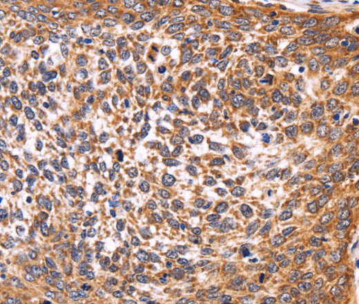 Immunohistochemistry of paraffin-embedded Human cervical cancer using AMIGO2 Polyclonal Antibody at dilution of 1:50