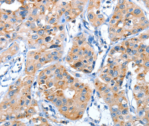 Immunohistochemistry of paraffin-embedded Human lung cancer using AUP1 Polyclonal Antibody at dilution of 1:50