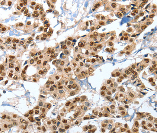 Immunohistochemistry of paraffin-embedded Human breast cancer tissue using ANXA10 Polyclonal Antibody at dilution 1:35