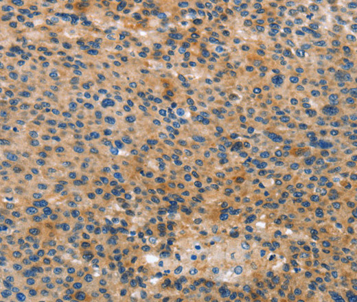 Immunohistochemistry of paraffin-embedded Human liver cancer tissue using ANXA10 Polyclonal Antibody at dilution 1:35