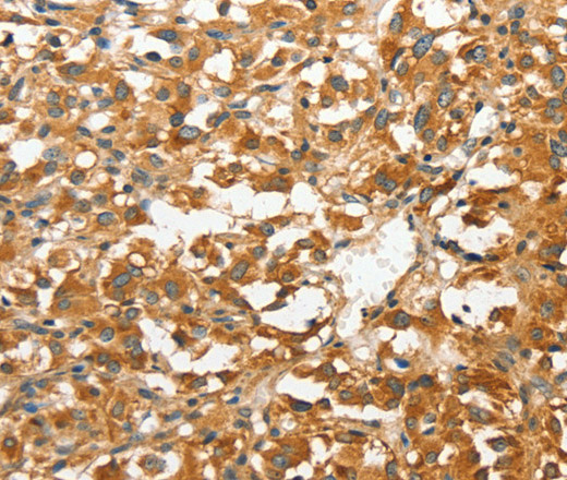 Immunohistochemistry of paraffin-embedded Human thyroid cancer tissue using ANXA9 Polyclonal Antibody at dilution 1:30