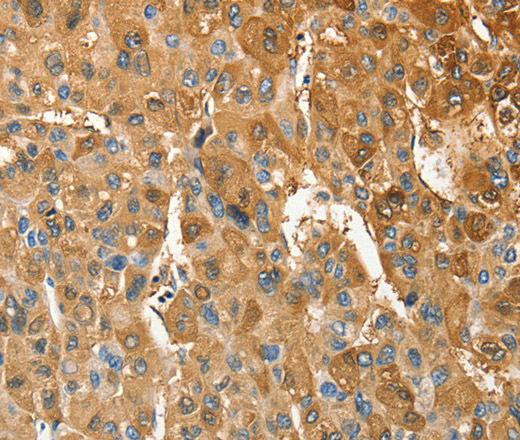 Immunohistochemistry of paraffin-embedded Human liver cancer tissue using ANXA9 Polyclonal Antibody at dilution 1:30