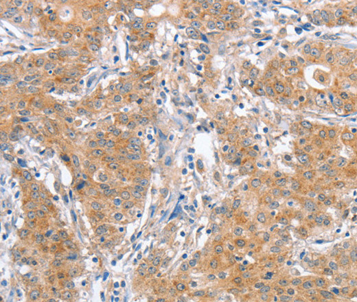 Immunohistochemistry of paraffin-embedded Human gasrtic cancer tissue using ATG12 Polyclonal Antibody at dilution 1:40