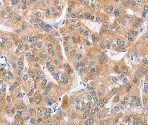 Immunohistochemistry of paraffin-embedded Human liver cancer tissue using ATG12 Polyclonal Antibody at dilution 1:40