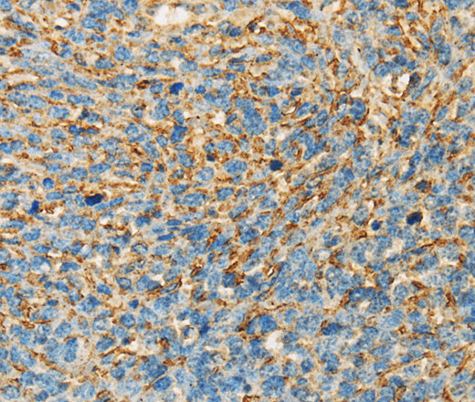 Immunohistochemistry of paraffin-embedded Human ovarian cancer tissue using APOA4 Polyclonal Antibody at dilution 1:30