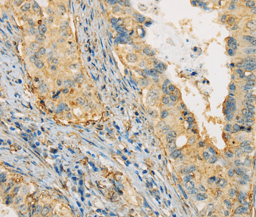 Immunohistochemistry of paraffin-embedded Human cervical cancer tissue using APOA4 Polyclonal Antibody at dilution 1:30