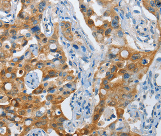 Immunohistochemistry of paraffin-embedded Human lung cancer tissue using NOL3 Polyclonal Antibody at dilution 1:35