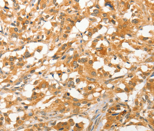 Immunohistochemistry of paraffin-embedded Human thyroid cancer tissue using APTX Polyclonal Antibody at dilution 1:50