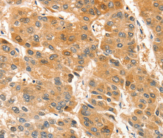 Immunohistochemistry of paraffin-embedded Human liver cancer tissue using APTX Polyclonal Antibody at dilution 1:50