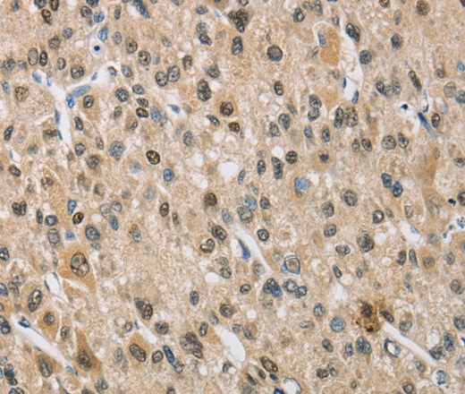 Immunohistochemistry of paraffin-embedded Human liver cancer using NAPSA Polyclonal Antibody at dilution of 1:50