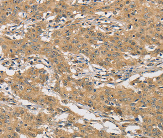 Immunohistochemistry of paraffin-embedded Human gasrtic cancer tissue using AMZ2 Polyclonal Antibody at dilution 1:60