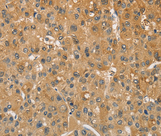 Immunohistochemistry of paraffin-embedded Human liver cancer tissue using AMZ2 Polyclonal Antibody at dilution 1:60