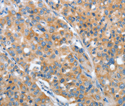 Immunohistochemistry of paraffin-embedded Human lung cancer using ARFGAP1 Polyclonal Antibody at dilution of 1:30