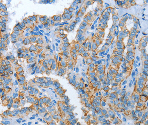 Immunohistochemistry of paraffin-embedded Human thyroid cancer tissue using ASL Polyclonal Antibody at dilution 1:35