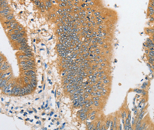 Immunohistochemistry of paraffin-embedded Human colon cancer tissue using ARHGAP5 Polyclonal Antibody at dilution 1:30