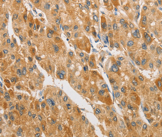 Immunohistochemistry of paraffin-embedded Human liver cancer tissue using ARHGAP5 Polyclonal Antibody at dilution 1:30