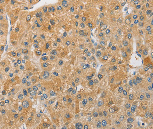 Immunohistochemistry of paraffin-embedded Human liver cancer tissue using ARHGAP15 Polyclonal Antibody at dilution 1:30