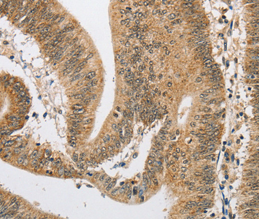 Immunohistochemistry of paraffin-embedded Human colon cancer using ARHGAP25 Polyclonal Antibody at dilution of 1:40